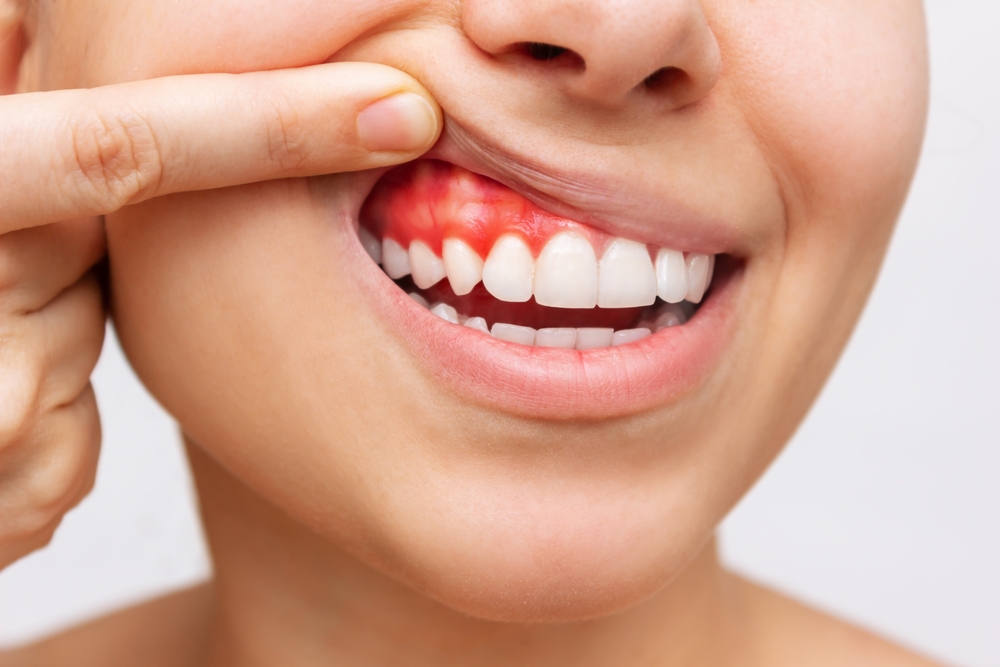 Houston Laser Dentistry For Periodontal Disease